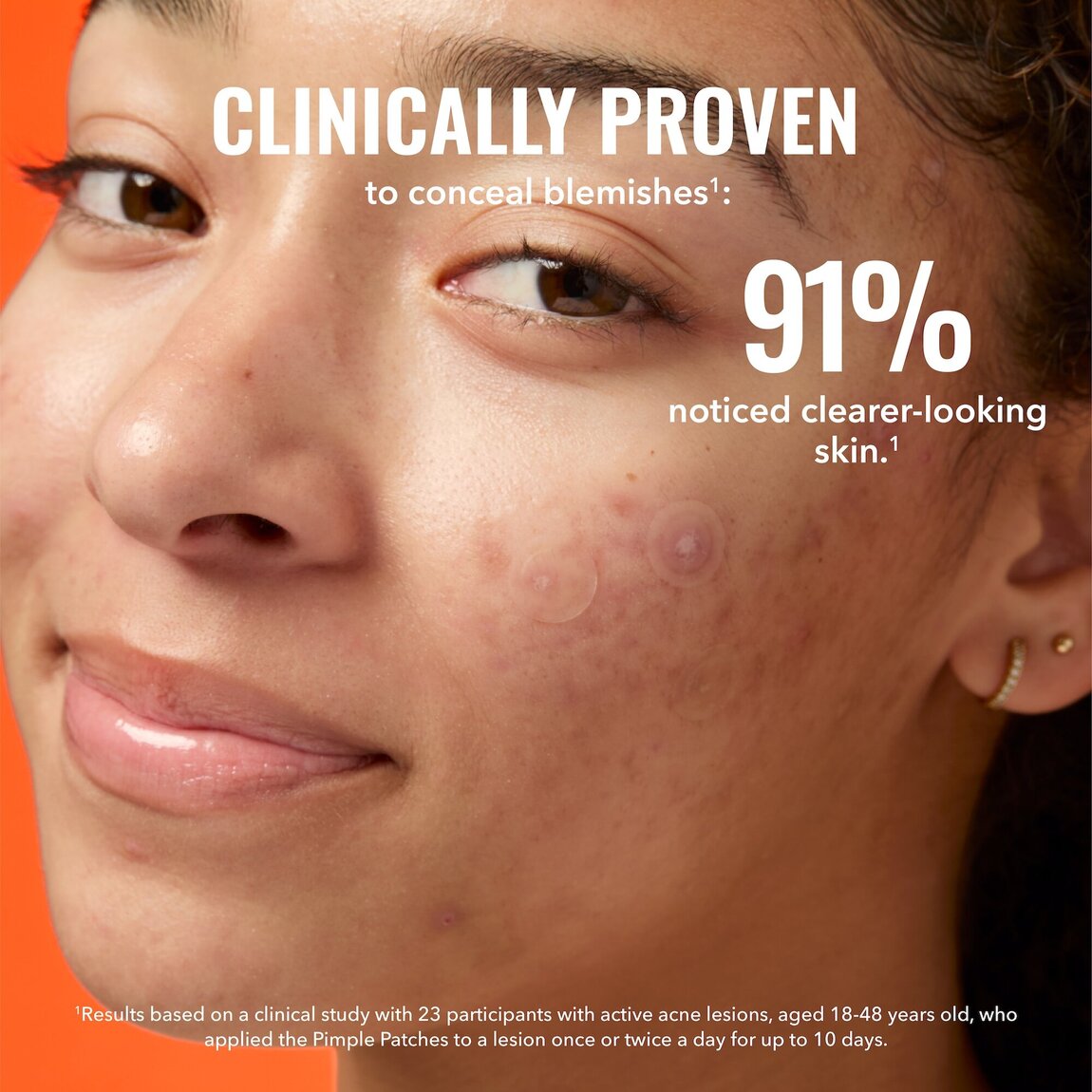 pimple-patches-g8 zb_p.jpg