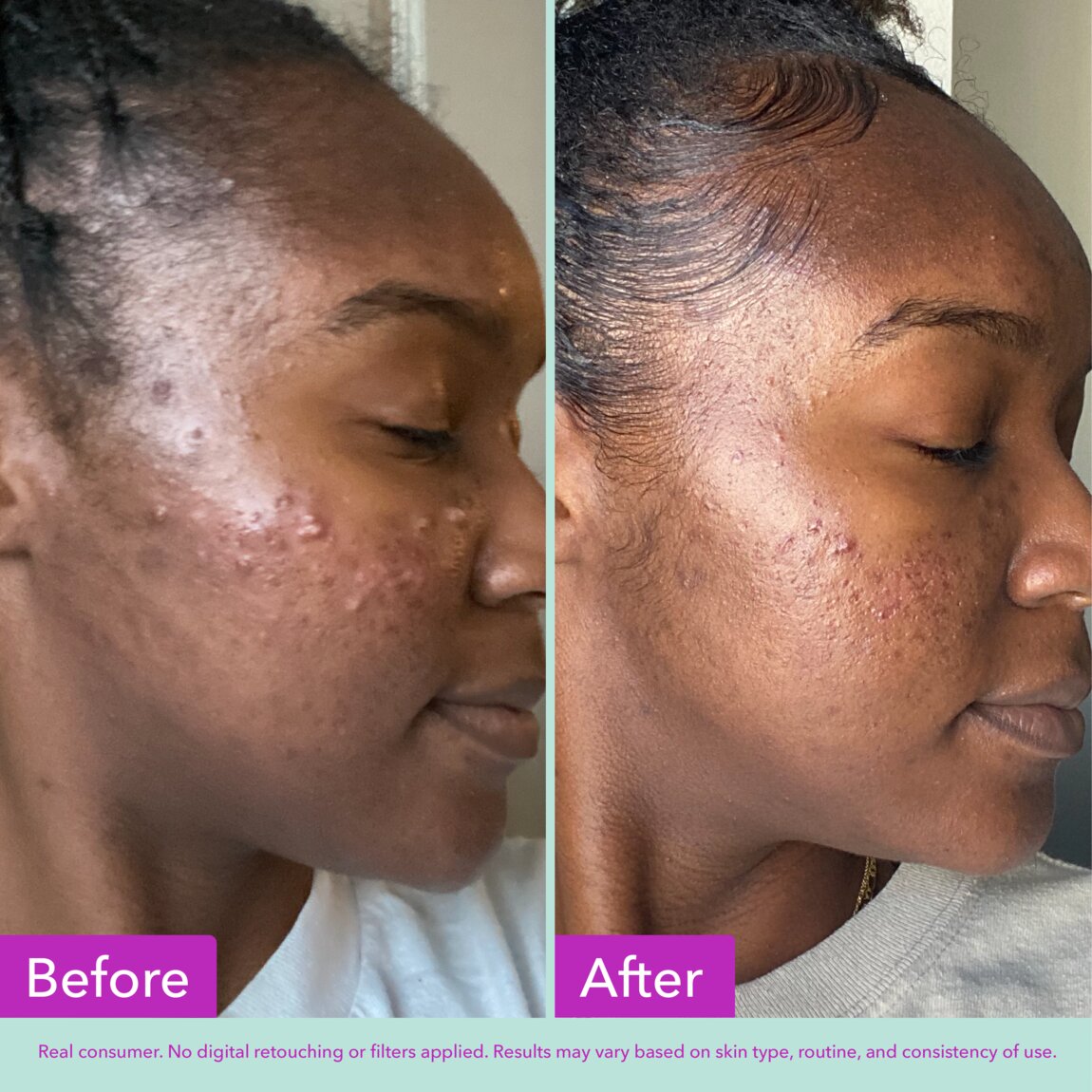 acne-foaming-cleanser-o7 zb_p.jpg